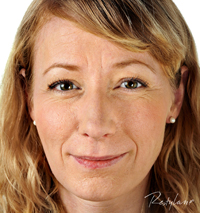Restylane Treatments London